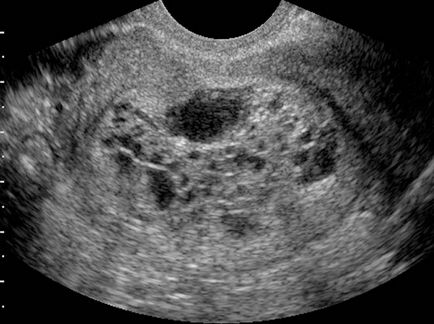 Atașarea embrionului în uter
