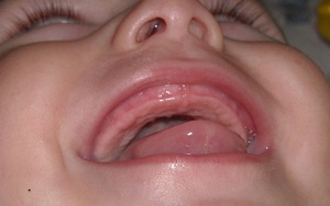 Dentiție simptome de dinți superioare la copii, fotografii ale gingiilor, cum să ajute copiii