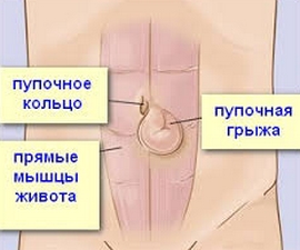 intervenție chirurgicală hernie ombilicala pentru a elimina