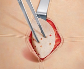 intervenție chirurgicală hernie ombilicala pentru a elimina