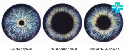 pupile dilatate