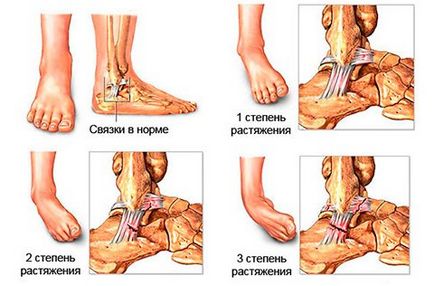 Entorse - cauze, simptome și tratament