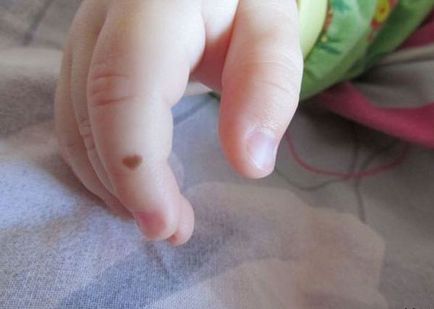 Birthmark pe deget - inel, indicele, mijloc, mână mare, dreapta și stânga, valoarea