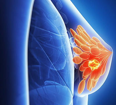 Sarcom a sânului care este, simptomele si tratamentul cancerului de sân la femei
