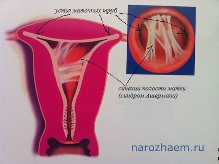 Adeziuni în simptomele uter si tratamentul problemelor de infertilitate și metodele de soluțiile lor de sex masculin și feminin