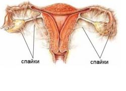 Adeziuni în ovare