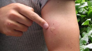 mușcături de țânțar - decât răspândirea, nu mancarimi