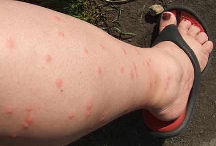 Mosquito musca îndepărtarea umflare și mâncărime