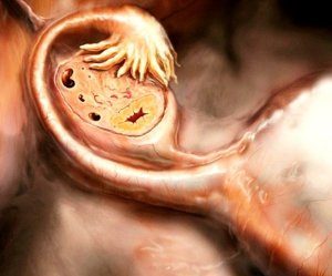 Cresterea in ovar la femei cauzele și posibilele patologii congenitale asociate cu dimensiunea glandelor
