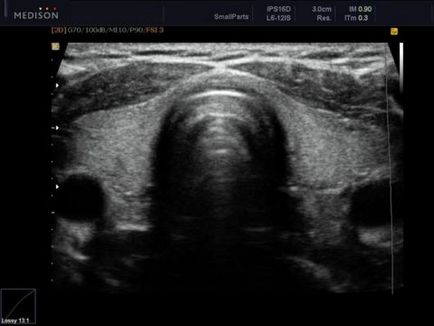 Rata de tiroidă Uzi în rândul femeilor și diagnosticul bolilor ale normelor