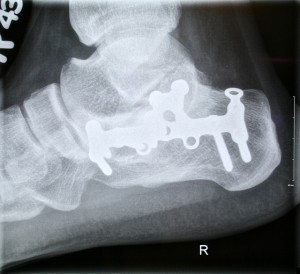 Tipuri de fracturi ale călcâiului și caracteristicile de tratament și reabilitare