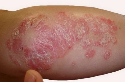 Inflamarea tipurilor de piele, cauze, simptome și tratament