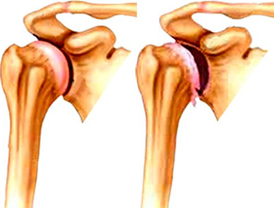 Inflamarea simptomele comune umăr și tratamentul capsulei articulare și căile de atac populare nervoase