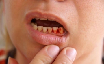 gingiile inflamate sunt dureroase și ce să facă și cum să trateze