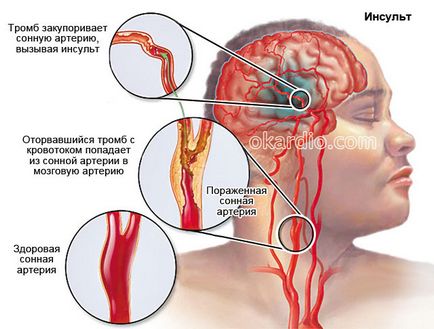 Toate simptomele unui accident vascular cerebral și primele semne ale unei revizuiri complete
