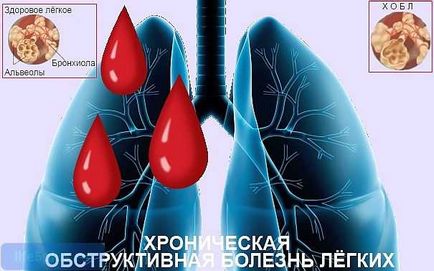 tratamentul bolilor pulmonare obstructive cronice