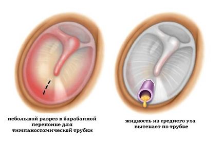 Lichid in urechea din spatele tratamentului timpanului de copii si adulti