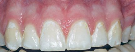 cariilor dentare, in stadiul alb tratament la fața locului, cauze, diagnostic si prevenire