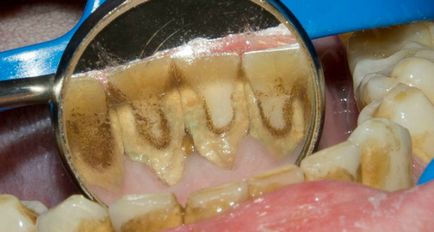 cariilor dentare, in stadiul alb tratament la fața locului, cauze, diagnostic si prevenire