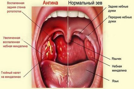 Adenoids tratate la copii