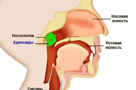 Adenoids tratate la copii