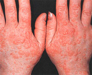 Alergia la această mână care