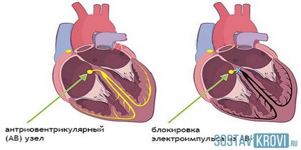 Ce este bloc cardiac incomplet