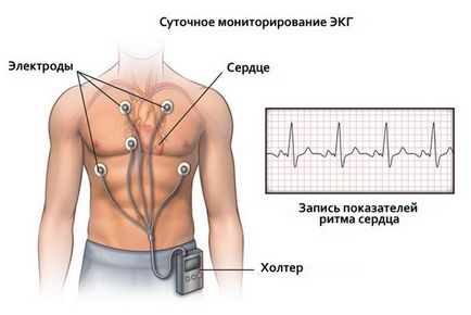 Ce este bloc cardiac incomplet