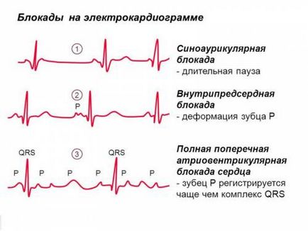 tipuri de bloc inima, măsura și modul de a trata simptomele