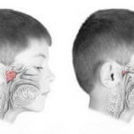 Adenoids tratate la copii