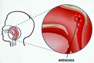Adenoids tratate la copii
