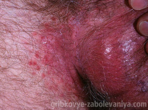Tratamentul ciuperca în zona abdomenului