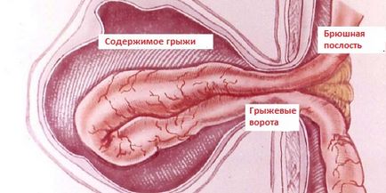 Cauzele hernia, simptome, tratament și clasificarea hernii