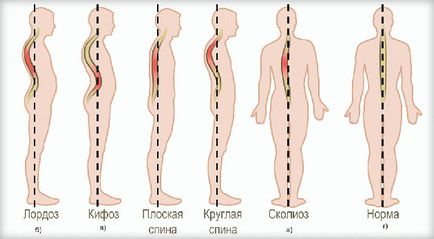 Cum să îndreptați coloanei vertebrale