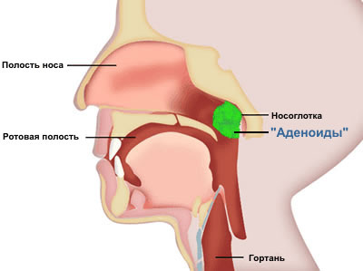 Adenoids tratate la copii