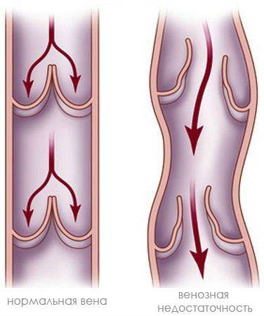 Cum de a consolida vaselor de sânge la nivelul picioarelor