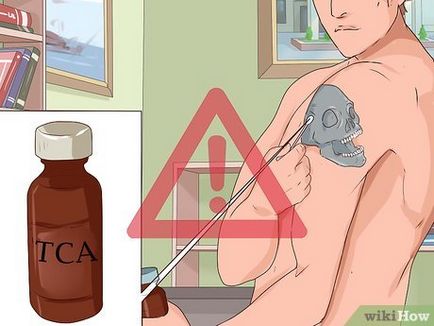 Cum și ce pentru a elimina un tatuaj Cum și ce pentru a elimina un tatuaj