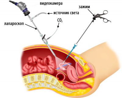 Ce este laparoscopia uterului