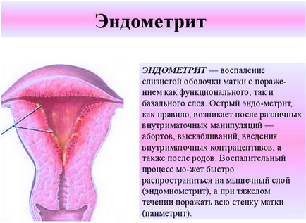 Tratamentul cronic endometritei de remedii populare
