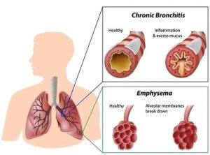 Tratamentul bronșită cronică obstructivă
