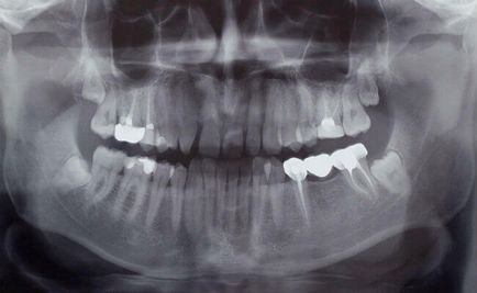 imagine panoramică dentară