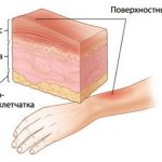 Această răspândire a arsurii