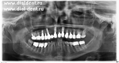 imagine panoramică dentară