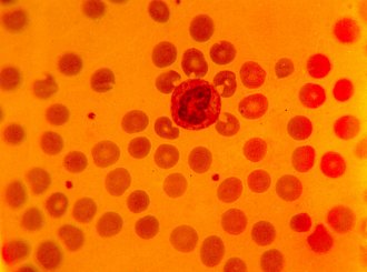 Din care celulele roșii din sânge în urină