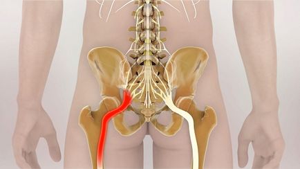 Decât pentru a trata sciatica