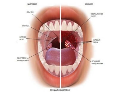Ce este Strep Throat