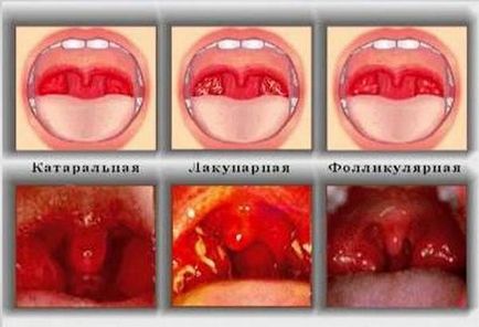Ce este Strep Throat