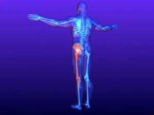 Sciatica cauze, simptome, tratament, medicamente și remedii populare