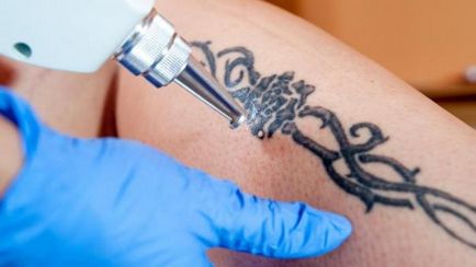 Cum și ce pentru a elimina un tatuaj