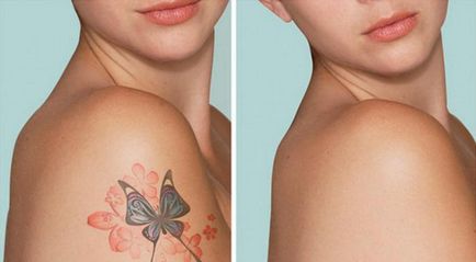 Cum și ce pentru a elimina un tatuaj Cum și ce pentru a elimina un tatuaj